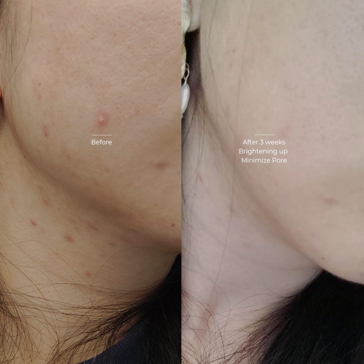 Reduces breakouts & Even out skin tone