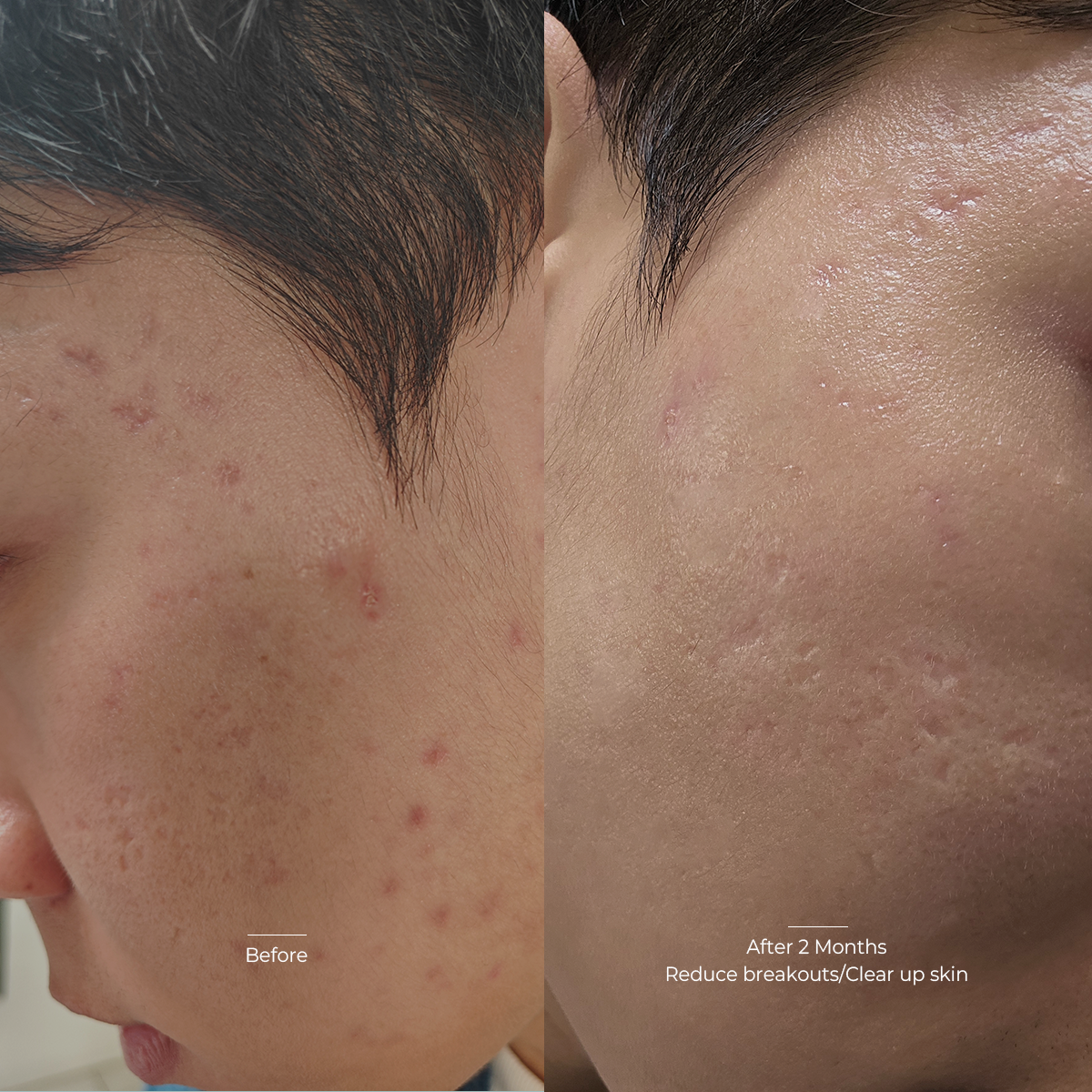 Reduces acne scars
